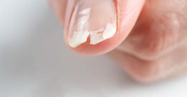 Fissura nas Unhas