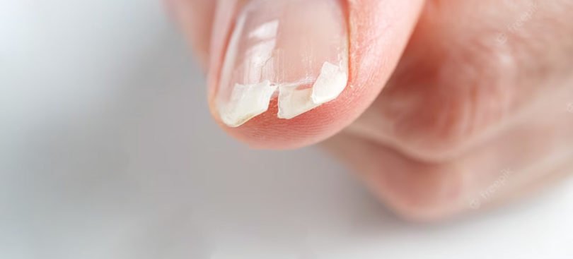 Fissura nas Unhas